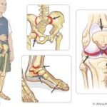 juvenile rheumatoid arthritis symptoms juvenile rheumatoid arthritis treatment jra symptoms childhood rheumatoid arthritis jra disease pediatric rheumatoid arthritis systemic juvenile rheumatoid arthritis rheumatoid arthritis in teens juvenile ra