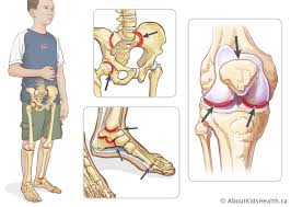 Juvenile Rheumatoid Arthritis: Means of Prevention
