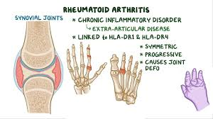 Inflammatory Arthritis
