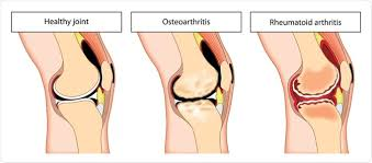 Arthritis and Rheumatoid Arthritis
