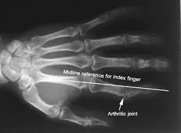 Arthritis in the Fingers