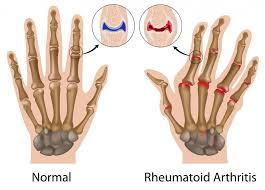 rheumatoid arthritis, rheumatoid arthritis symptoms,RA Treatments