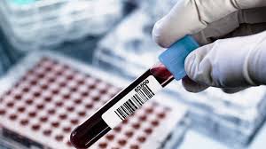 Rheumatoid Factor: Causes, Testing, and Its Role in Rheumatoid Arthritis