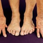 arthritis and rheumatoid arthritis rheumatoid arthritis ra disease arthritis rheumatoid arthritis ra rheumatoid arthritis symptoms rheumatologist