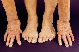 Arthritis and Rheumatoid Arthritis: Treatments and Conditions