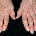 arthritis in fingers treatment for rheumatoid arthritis in fingers psoriatic arthritis fingers rheumatoid arthritis fingers sore finger joints rheumatoid arthritis thumb best supplements for arthritis in hands stiff finger joints arthritis in your fingers knuckle pain in one finger