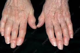 Arthritis in the Fingers: Causes and Prevention