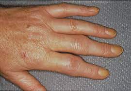 RA: Early Signs of Rheumatoid Arthritis